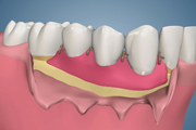 Alloderm Recession Treatment